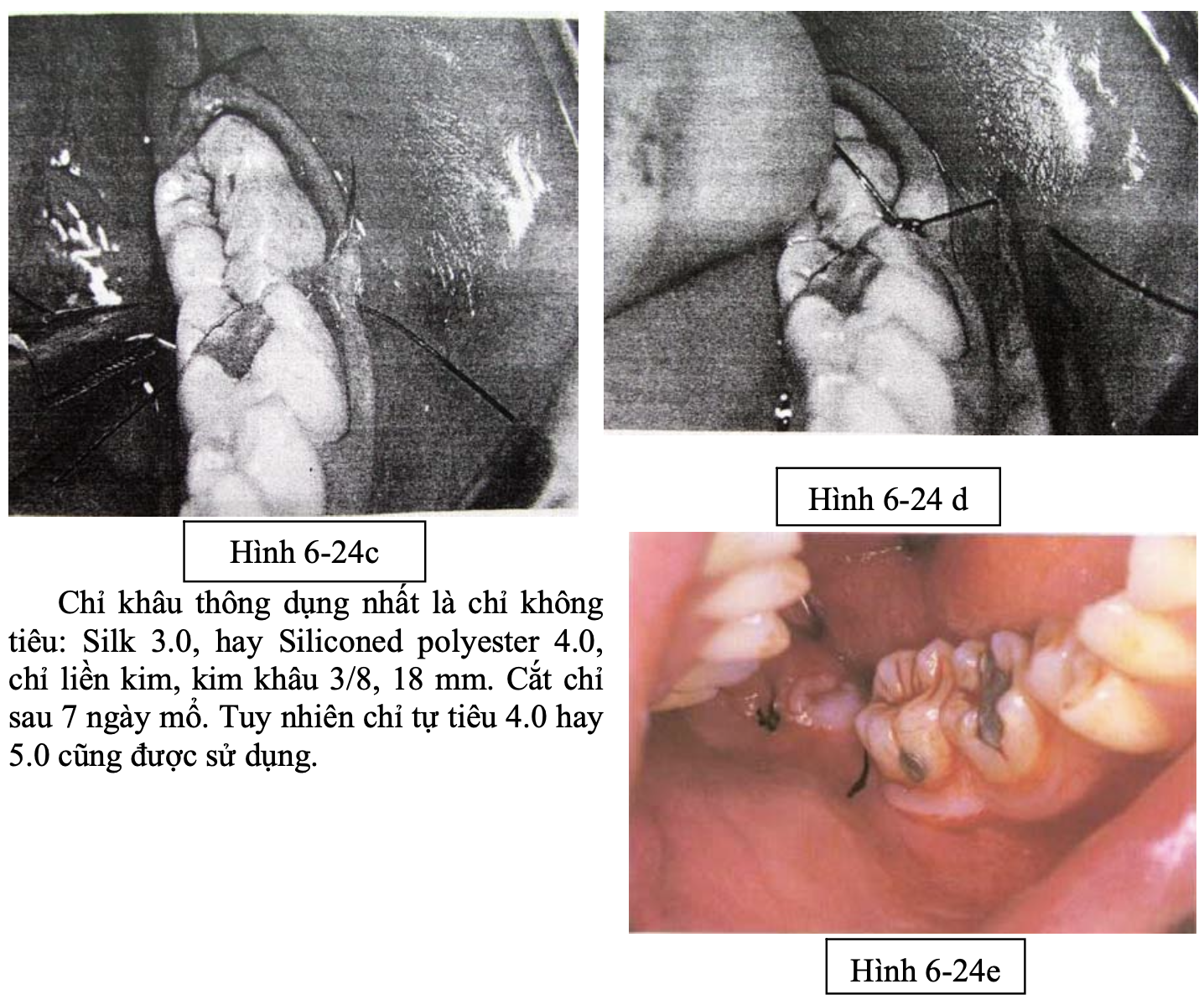 Quy trình phẫu thuật răng khôn: những nguyên tắc cơ bản